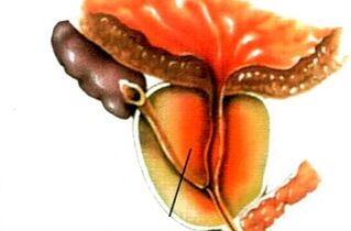 Que é a prostatite nos homes
