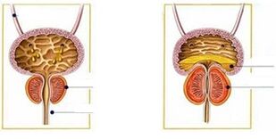 Tipos e formas de prostatite en homes