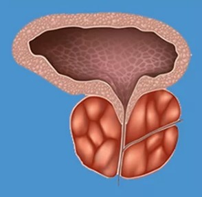 Síntomas típicos de prostatite