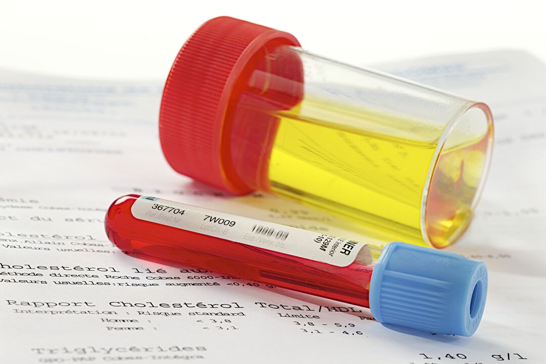 Unha proba de sangue e orina axudará a determinar a presenza de prostatite.